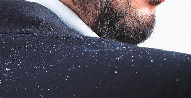 علت «شوره سر» و راه درمان آن چیست؟